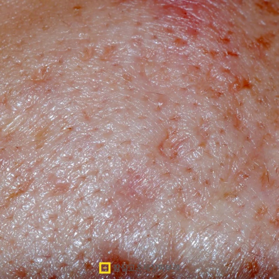 여드름 흉터, 왜 유형에 따라 치료 방법이 달라져야 할까? 관련 이미지 2