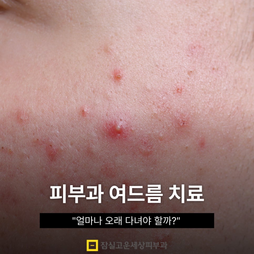 피부과 여드름 치료, 얼마나 오래 다녀야 하나요? 관련 이미지 1