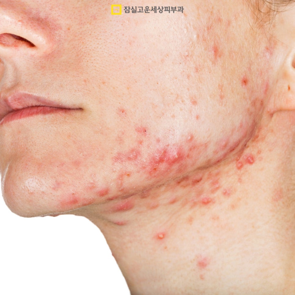 여드름 완전 정복, 원인부터 치료까지 관련 이미지 3