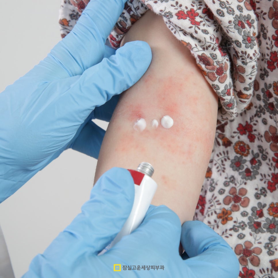 아토피 피부염, 일상에서 지키는 4가지 핵심 관리법 관련 이미지 2