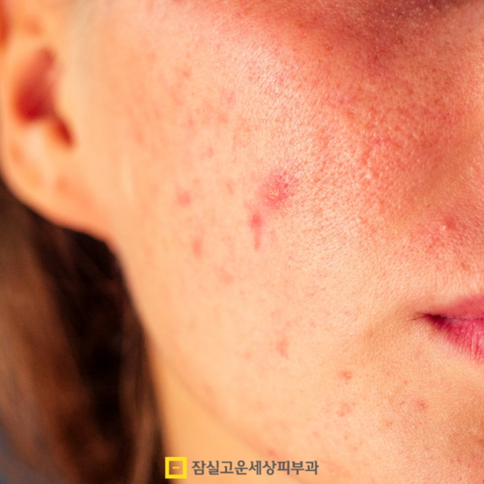 갑자기 트러블이 많아졌다면, 환절기 알러지성 피부일 수도 있어요 관련 이미지 4