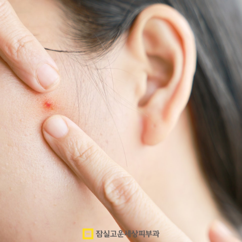 여드름 패치, 상황에 맞게 제대로 쓰는 법 관련 이미지 3