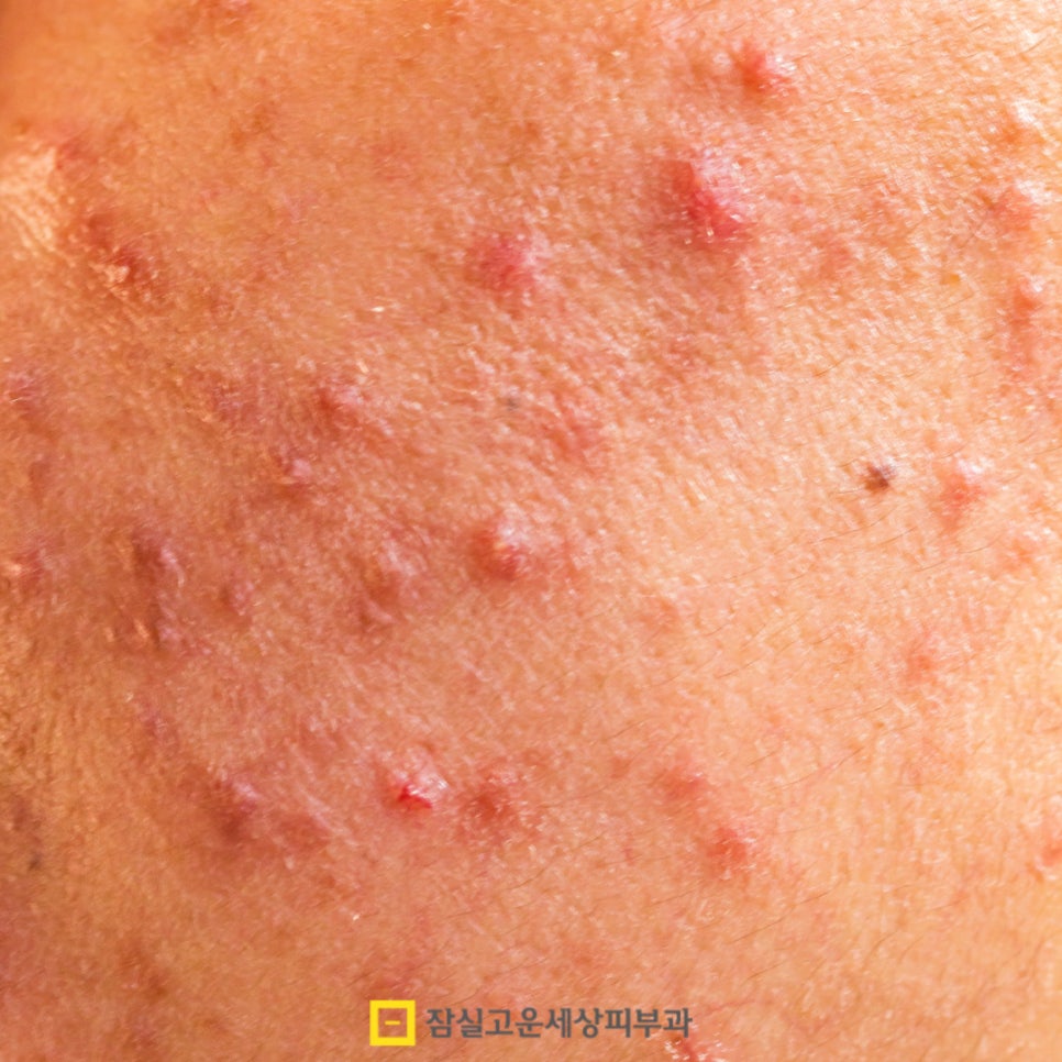 여드름, 단순한 뾰루지가 아닌 피부 질환 관련 이미지 6