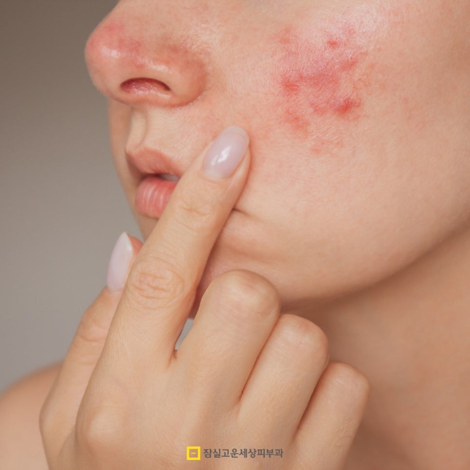 무덥고 습한 여름철 여드름 관리법 6가지 관련 이미지 2
