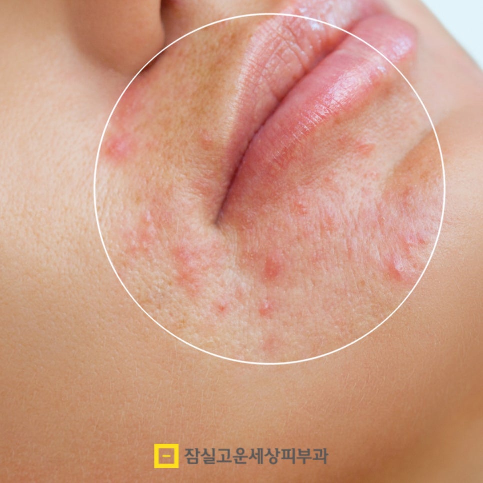 좁쌀 여드름, 왜 자꾸 올라올까요? 관련 이미지 3