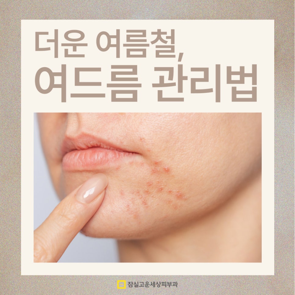 무덥고 습한 여름철 여드름 관리법 6가지 관련 이미지 1