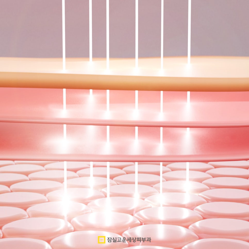 여드름 레이저 치료, 어떻게 작용하고 몇 번 받아야 할까? 관련 이미지 3