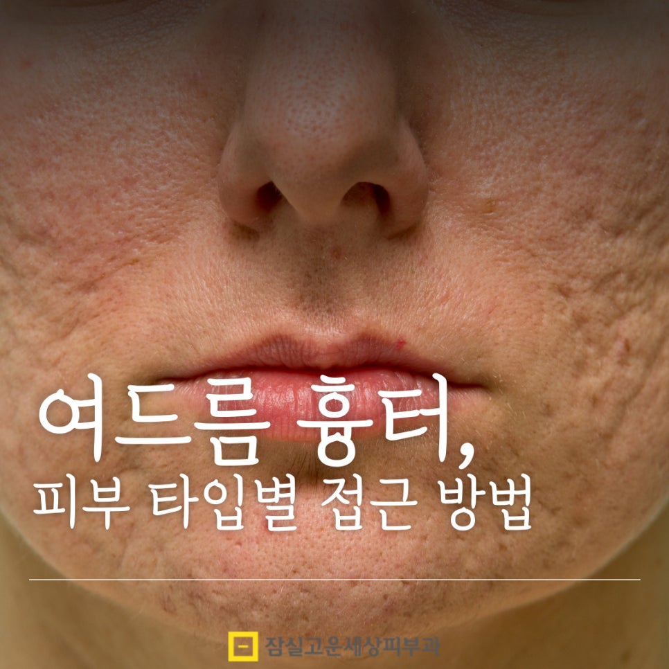 여드름 흉터 치료, 피부 타입별로 접근이 달라야 하는 이유 관련 이미지 1