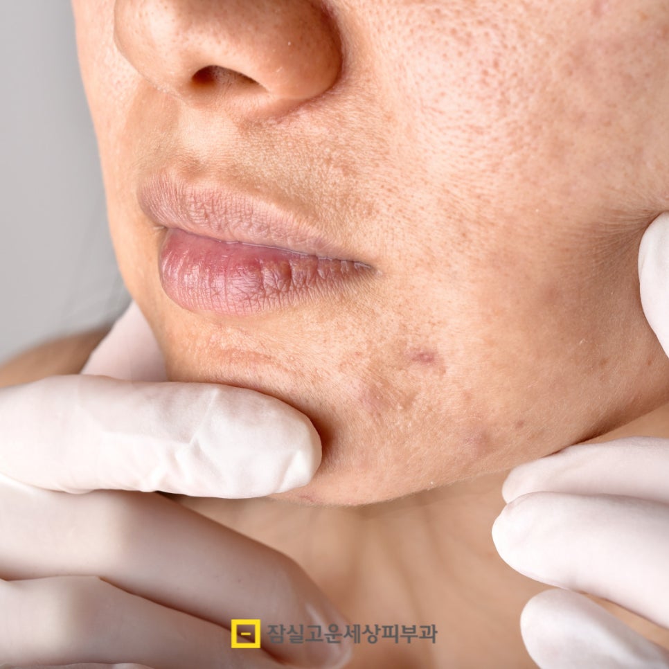 여드름, 왜 흉터로 남을까? 그리고 어떻게 예방할까? 관련 이미지 9