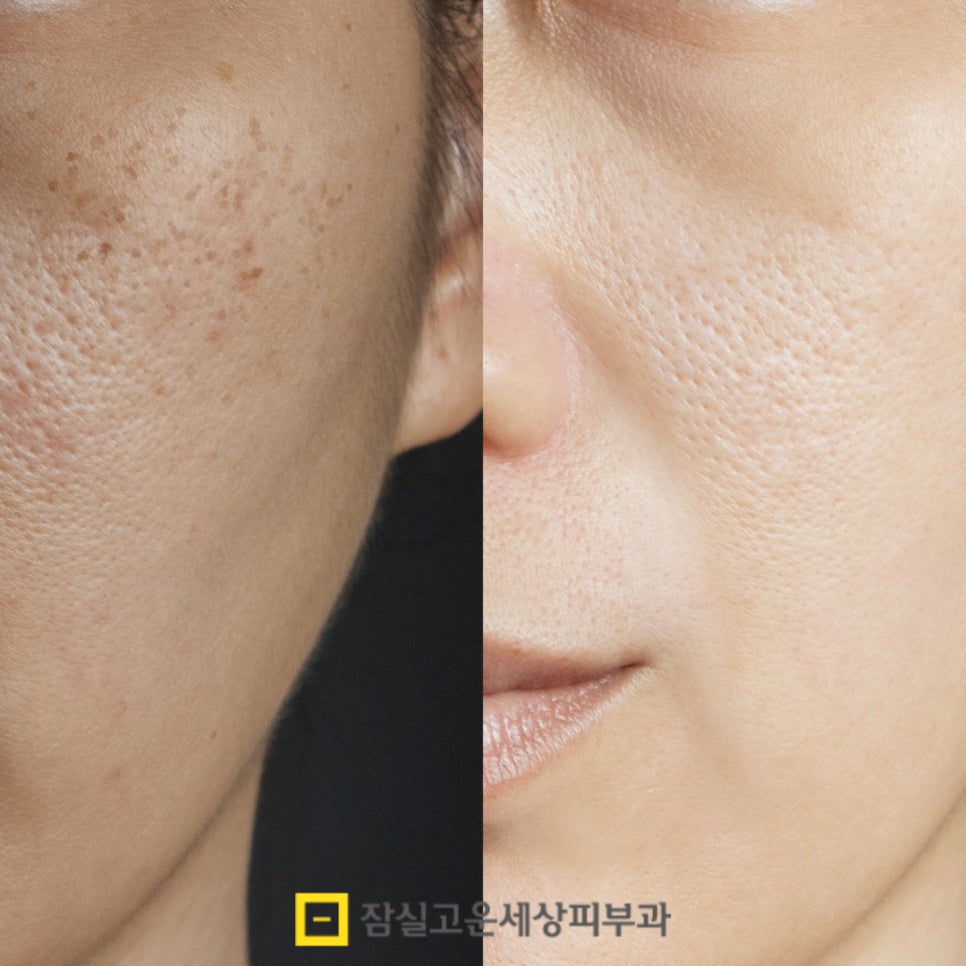 피부에 생기는 기미와 잡티, 지금부터 관리 시작해야 합니다. 관련 이미지 2