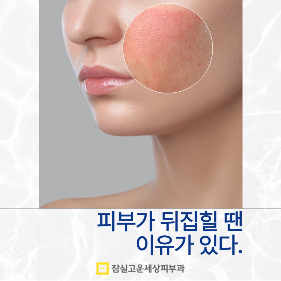 피부가 뒤집힐 땐 이유가 있습니다. 관련 이미지 1