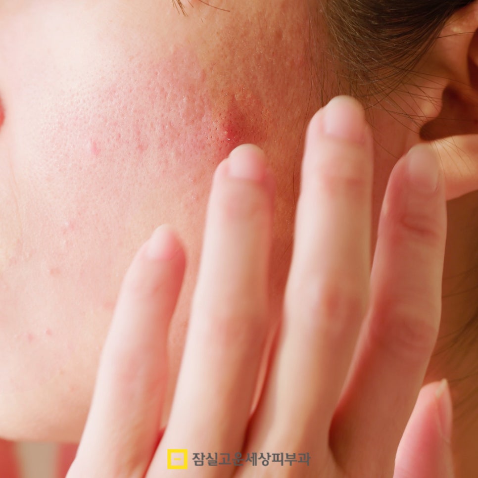 진정이냐 보습이냐, 환절기 피부에 필요한 건? 관련 이미지 2