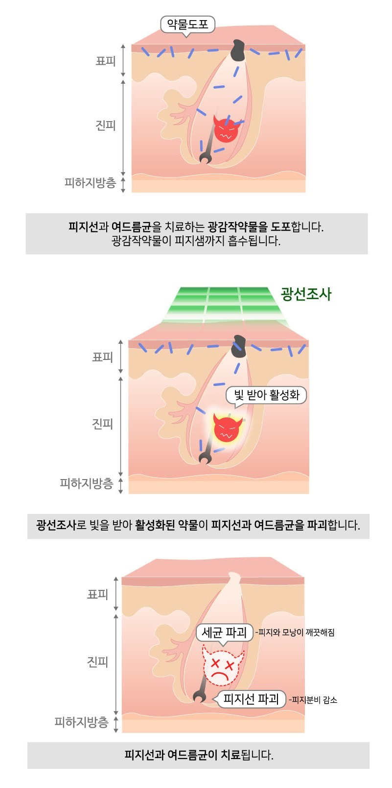 지속되는 여드름, 원인과 치료 방법 관련 이미지 6