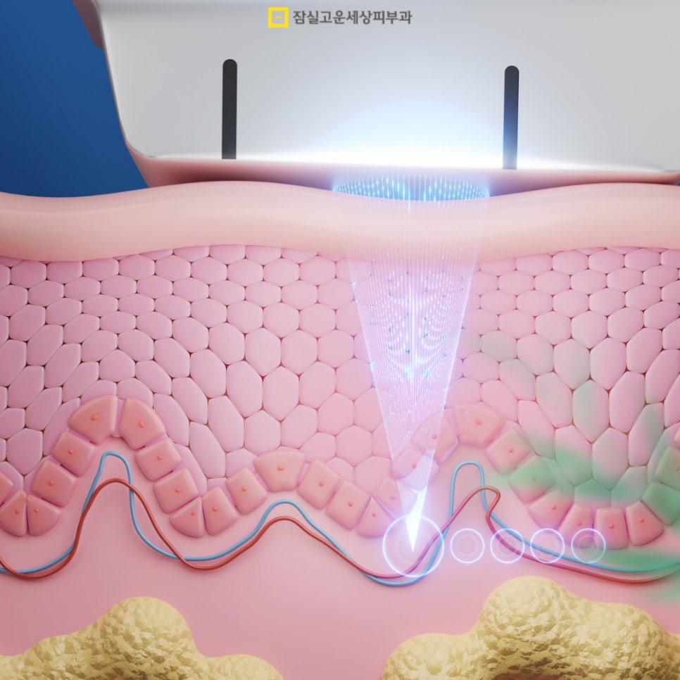 기미 원인부터 치료 방법, 예방이 중요한 이유까지 관련 이미지 4