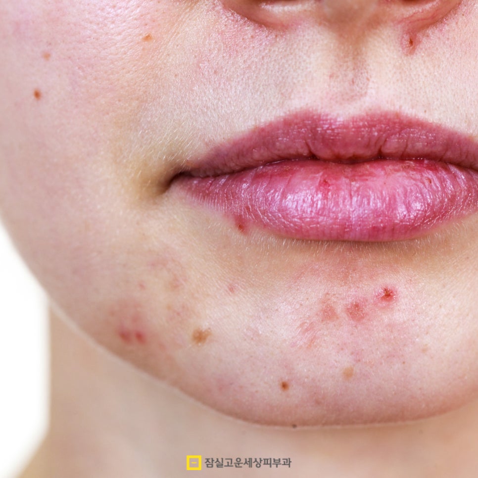 여드름, 반복되는 고민에서 벗어나려면? 관련 이미지 12