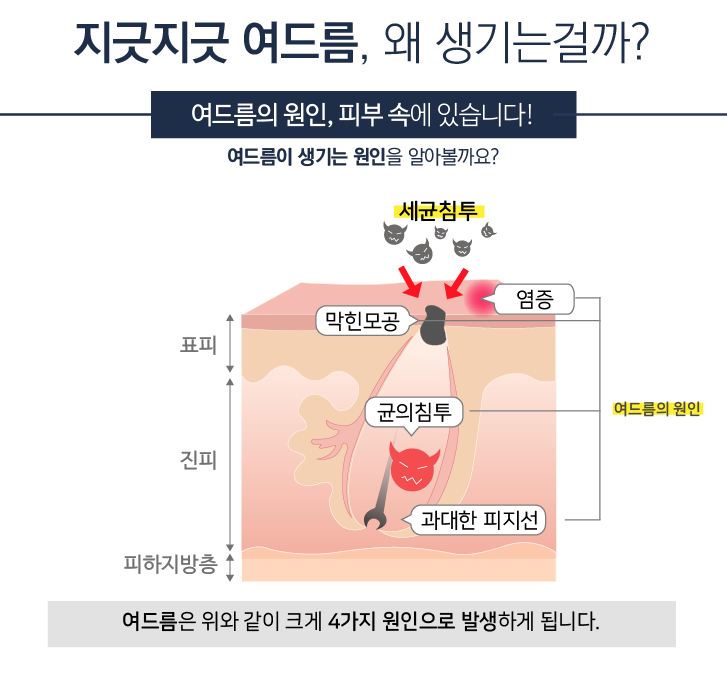 잠실에서만 만나보실 수 있는 특별한 핌클케어 프로그램! (잠실고운세상/여드름치료/핌클케어/잠실여드름피부과) 관련 이미지 3