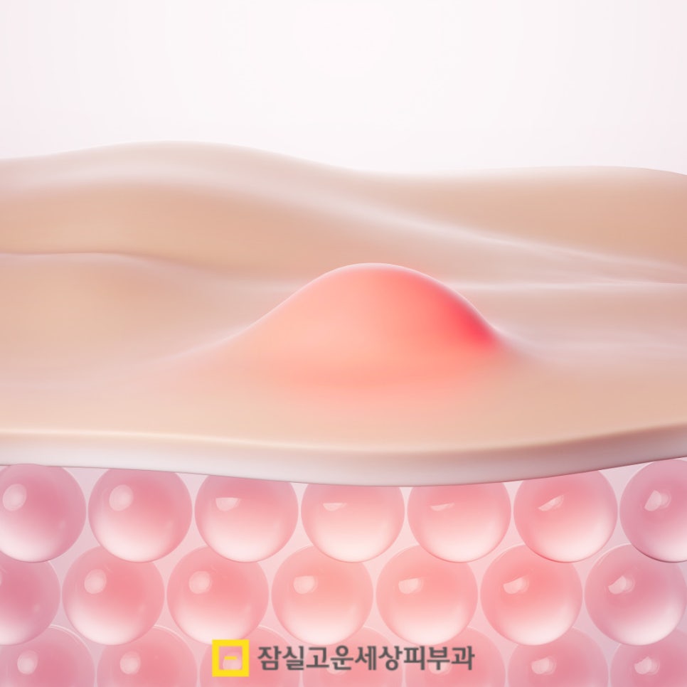 이마 여드름, 왜 자꾸 생길까? 관련 이미지 2