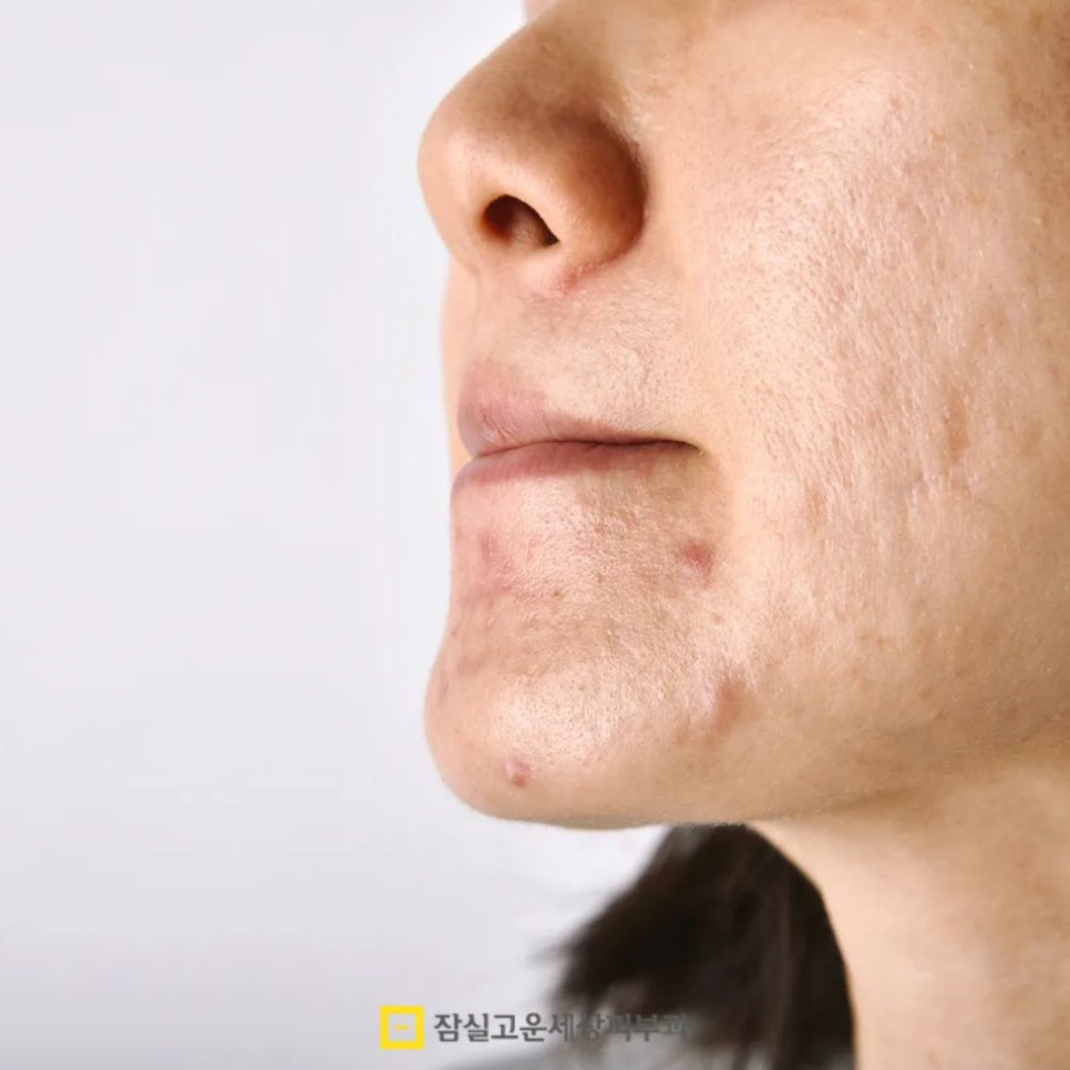 여드름 흉터, 왜 유형에 따라 치료 방법이 달라져야 할까? 관련 이미지 8