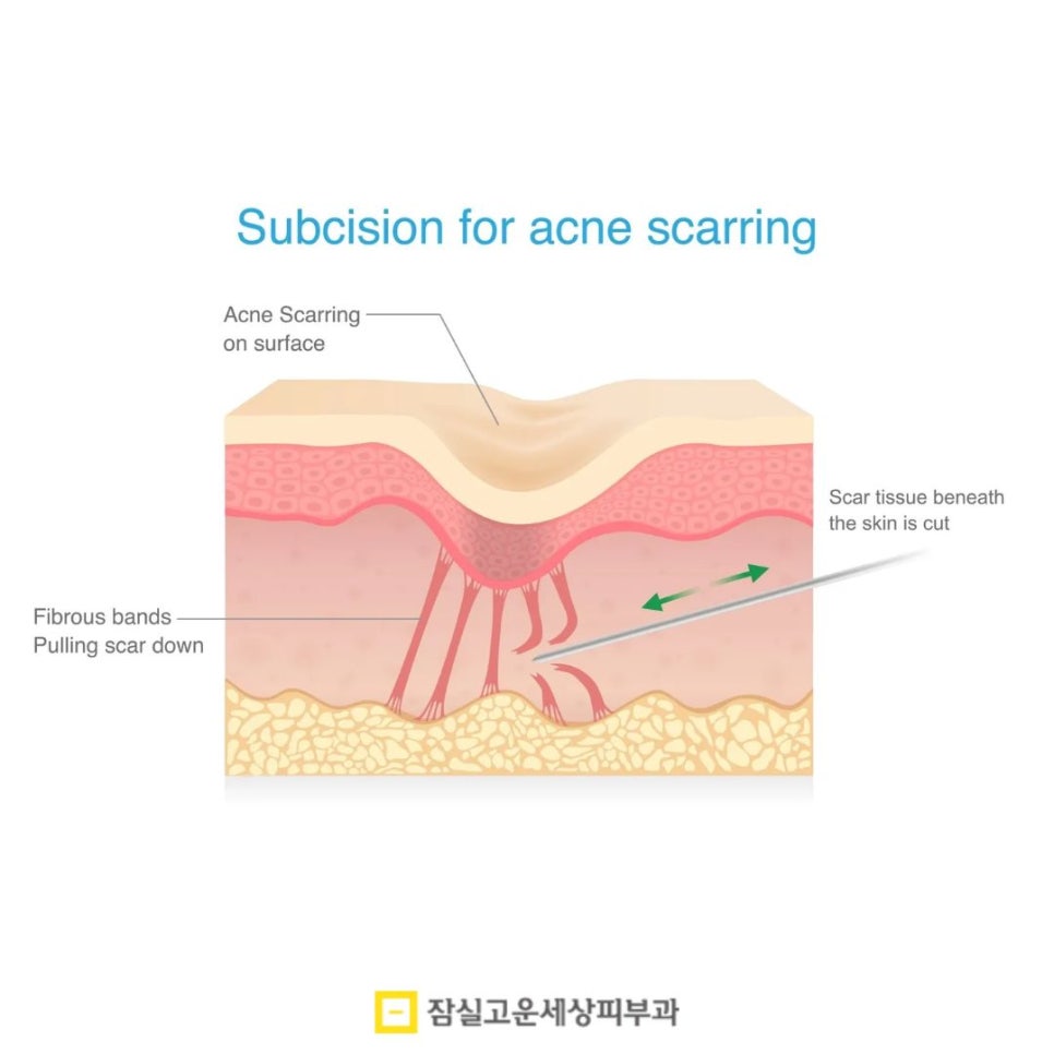 여드름 흉터, 왜 유형에 따라 치료 방법이 달라져야 할까? 관련 이미지 5