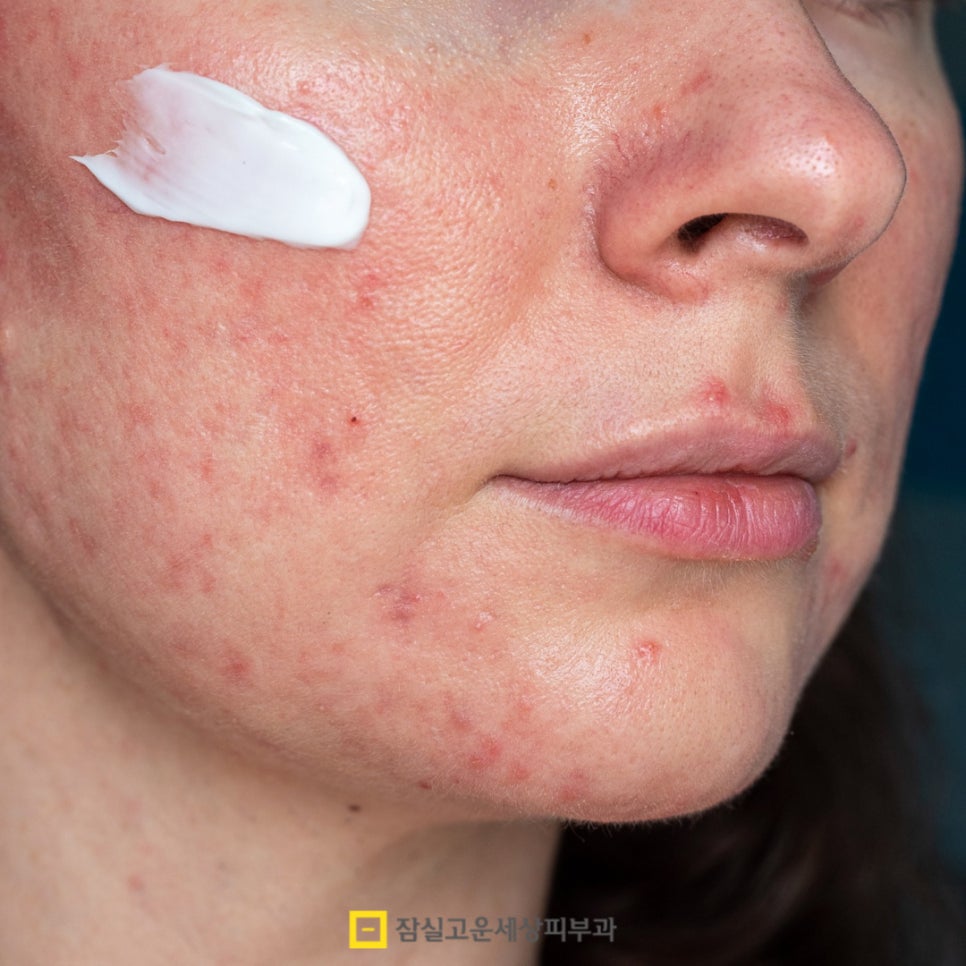 붉고 고름 찬 화농성 여드름의 원인부터 치료까지 관련 이미지 7