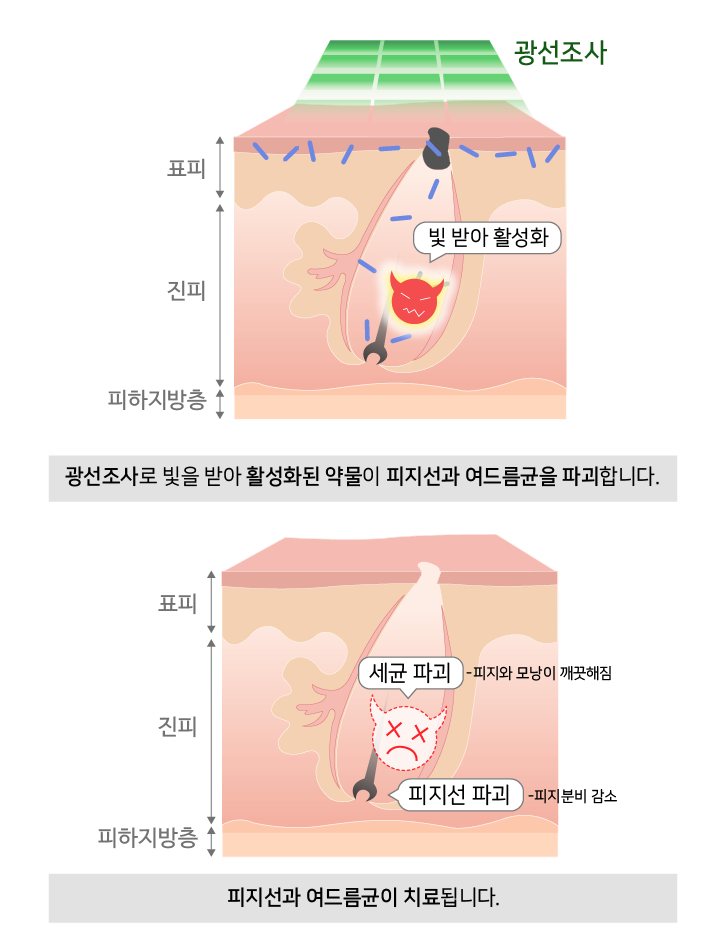 잠실에서만 만나보실 수 있는 특별한 핌클케어 프로그램! (잠실고운세상/여드름치료/핌클케어/잠실여드름피부과) 관련 이미지 5