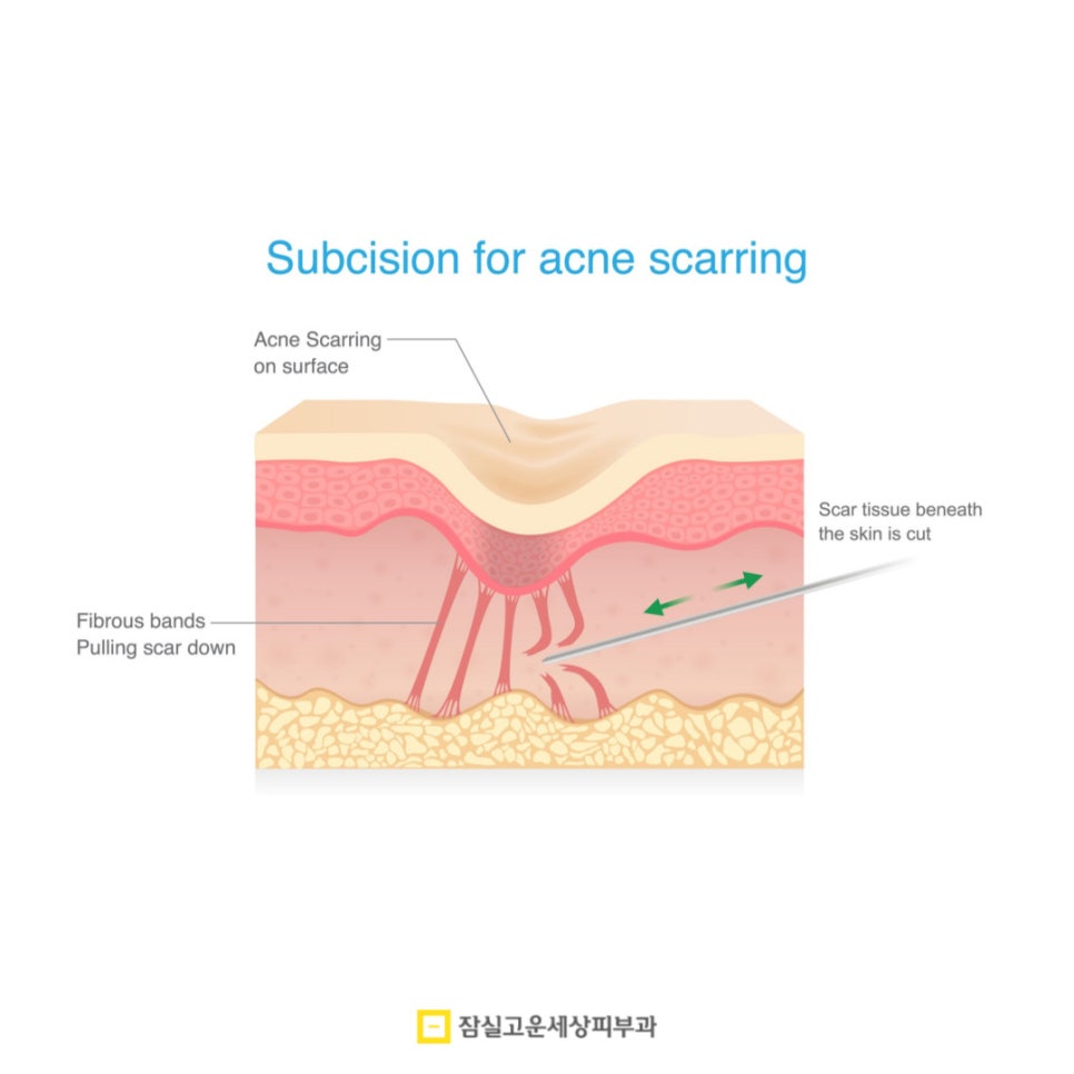 여드름 흉터, 시간이 지나도 사라지지 않는 이유 관련 이미지 6