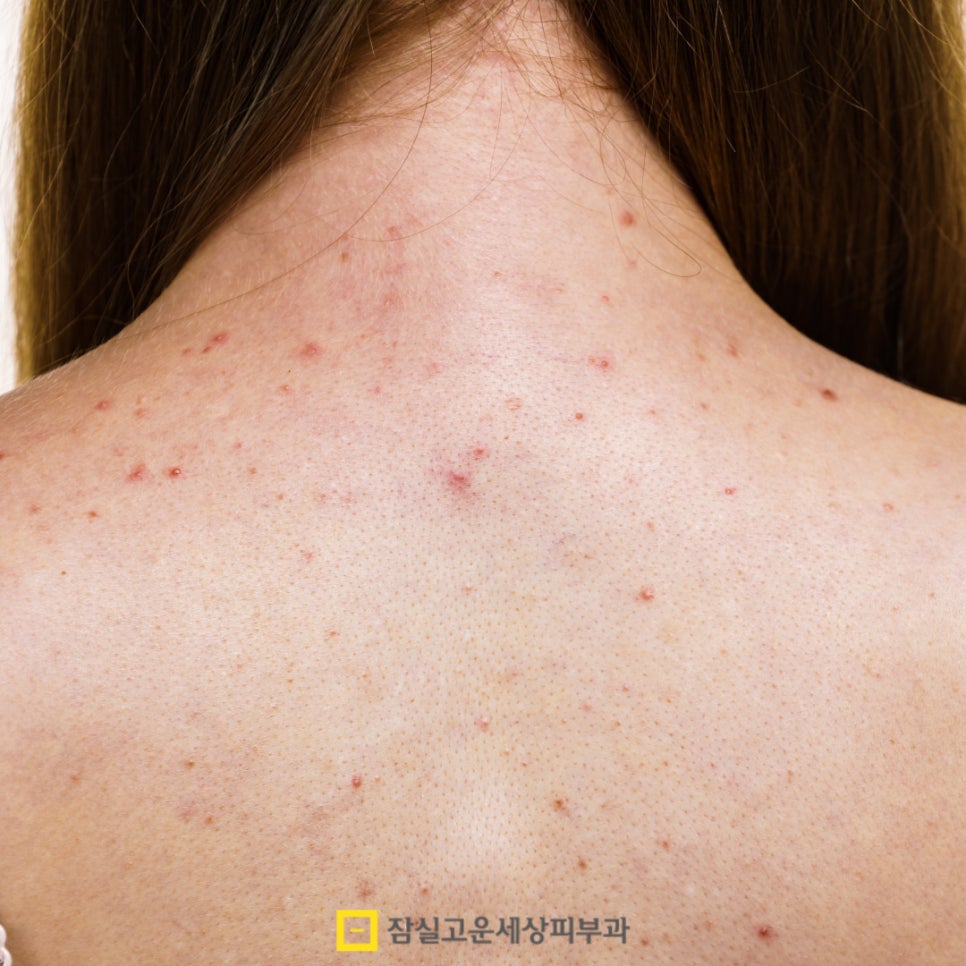 여드름, 단순한 뾰루지가 아닌 피부 질환 관련 이미지 2