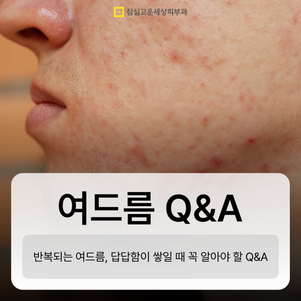 여드름 Q&A, 주요 궁금증들 관련 이미지 1