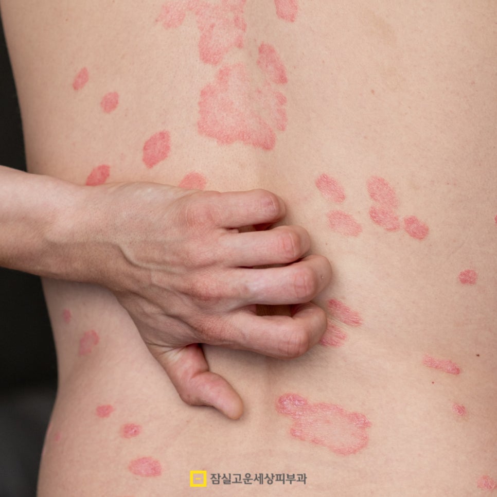 반복되는 하얀 각질과 붉은 반점, 건선일 수 있어요 관련 이미지 4