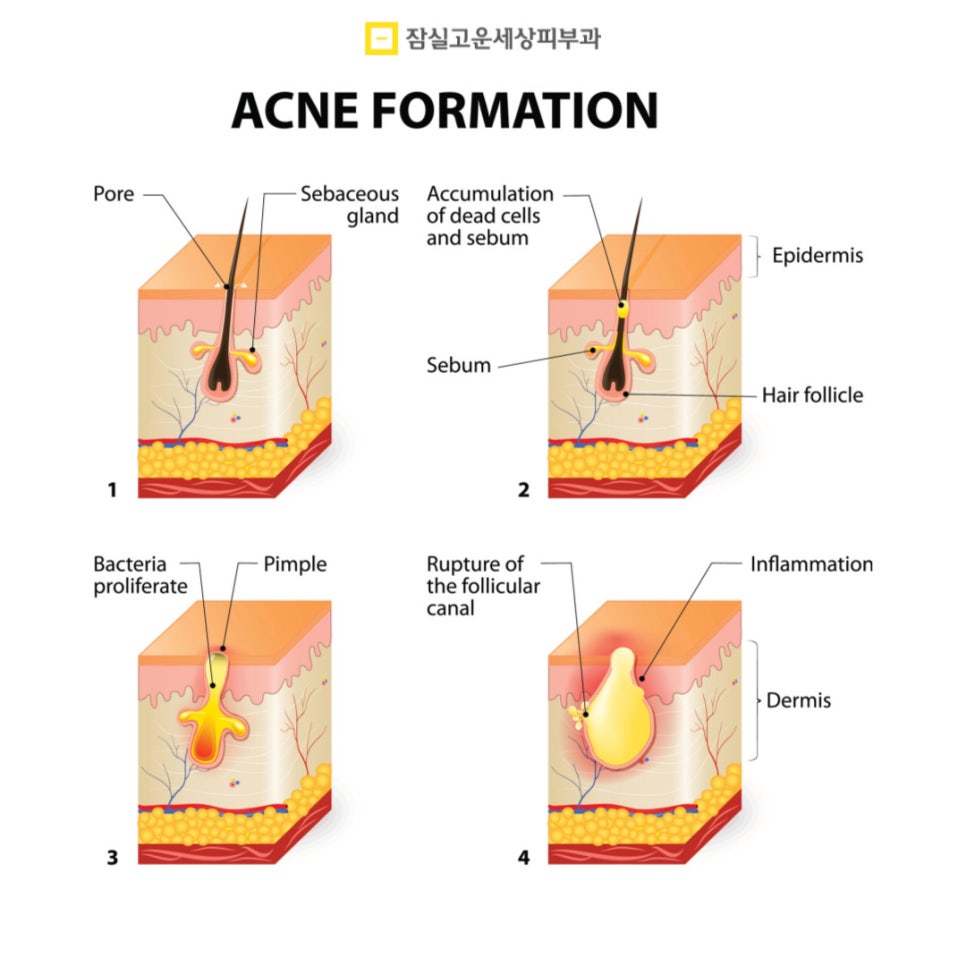 여드름 Q&A, 주요 궁금증들 관련 이미지 5