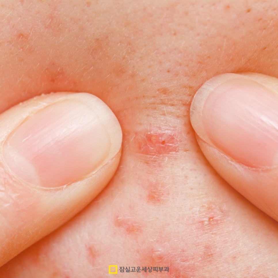 여름철 등드름과 가드름 완전 정복! 시원한 옷차림을 위한 완벽 가이드 관련 이미지 10