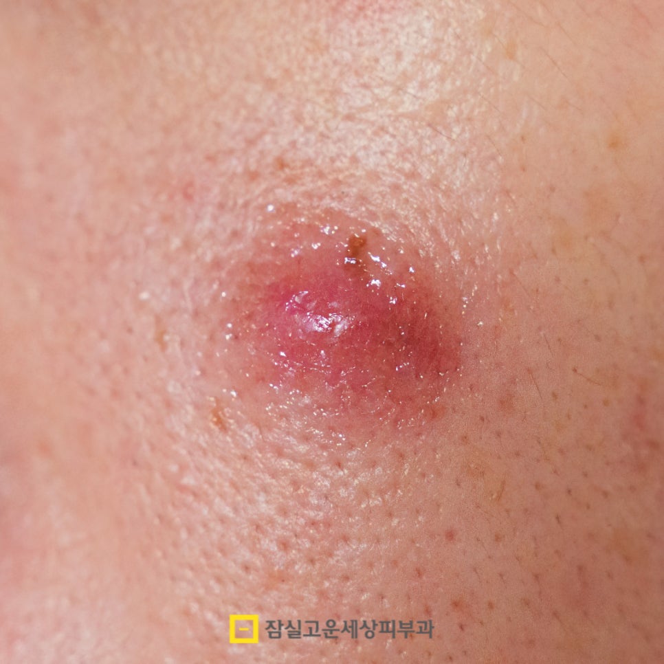 여드름, 왜 흉터로 남을까? 그리고 어떻게 예방할까? 관련 이미지 3