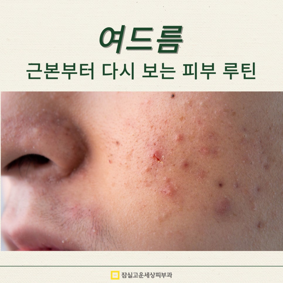 여드름, 근본부터 다시 보는 피부 루틴 관련 이미지 1