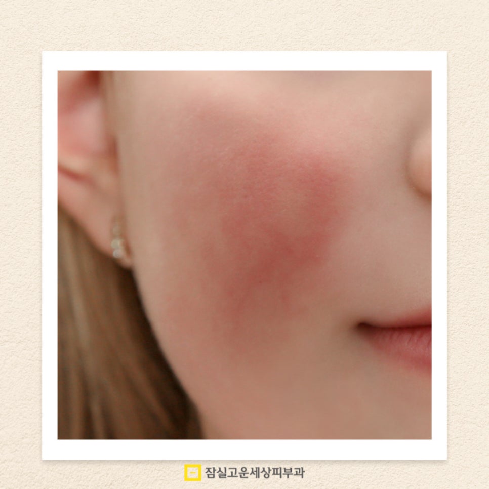 피부가 예민해지는 이유와 건강하게 관리하는 방법 관련 이미지 2