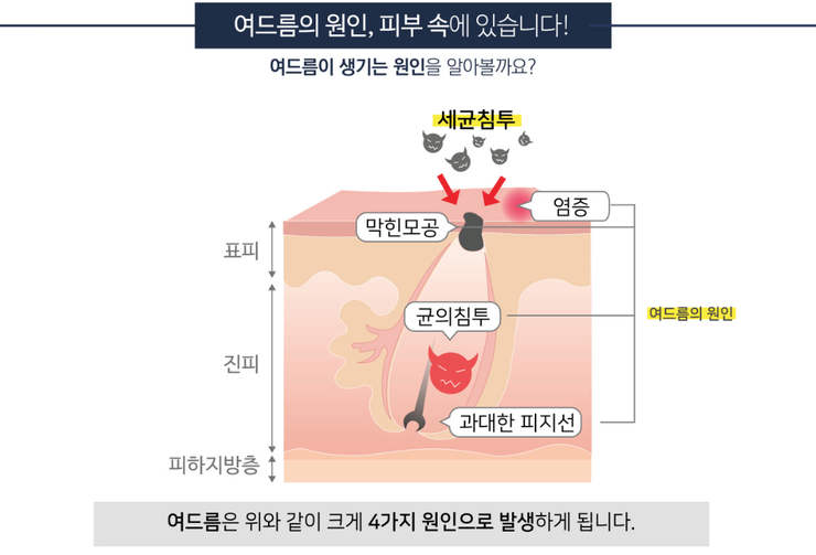 여드름치료는 J핌클케어 (잠실고운세상피부과/잠실피부과추천/잠실여드름피부과추천) 관련 이미지 3
