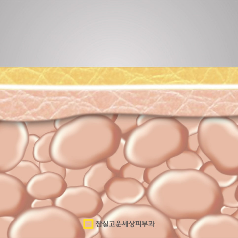 모공각화증, 단순한 관련 이미지 5