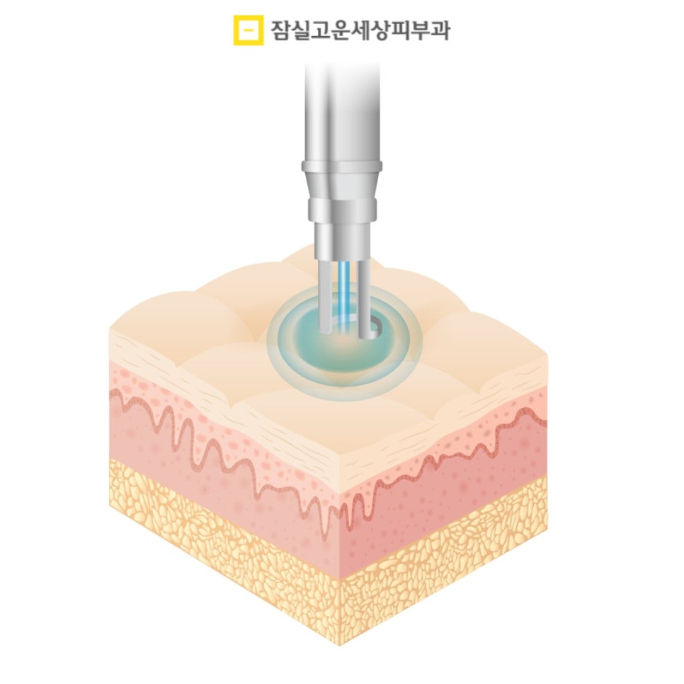 기미 치료의 올바른 접근 방법 관련 이미지 3