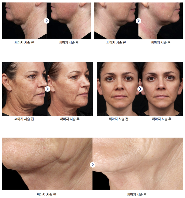 피부탄력 걱정된다면 잠실피부과 No.1 리프팅레이저! (리프팅/써마지CPT/잠실고운세상) 관련 이미지 8