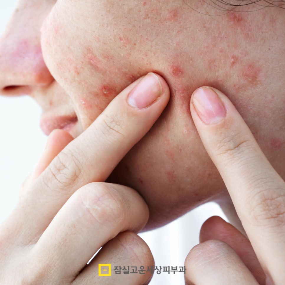 여드름, 왜 흉터로 남을까? 그리고 어떻게 예방할까? 관련 이미지 4