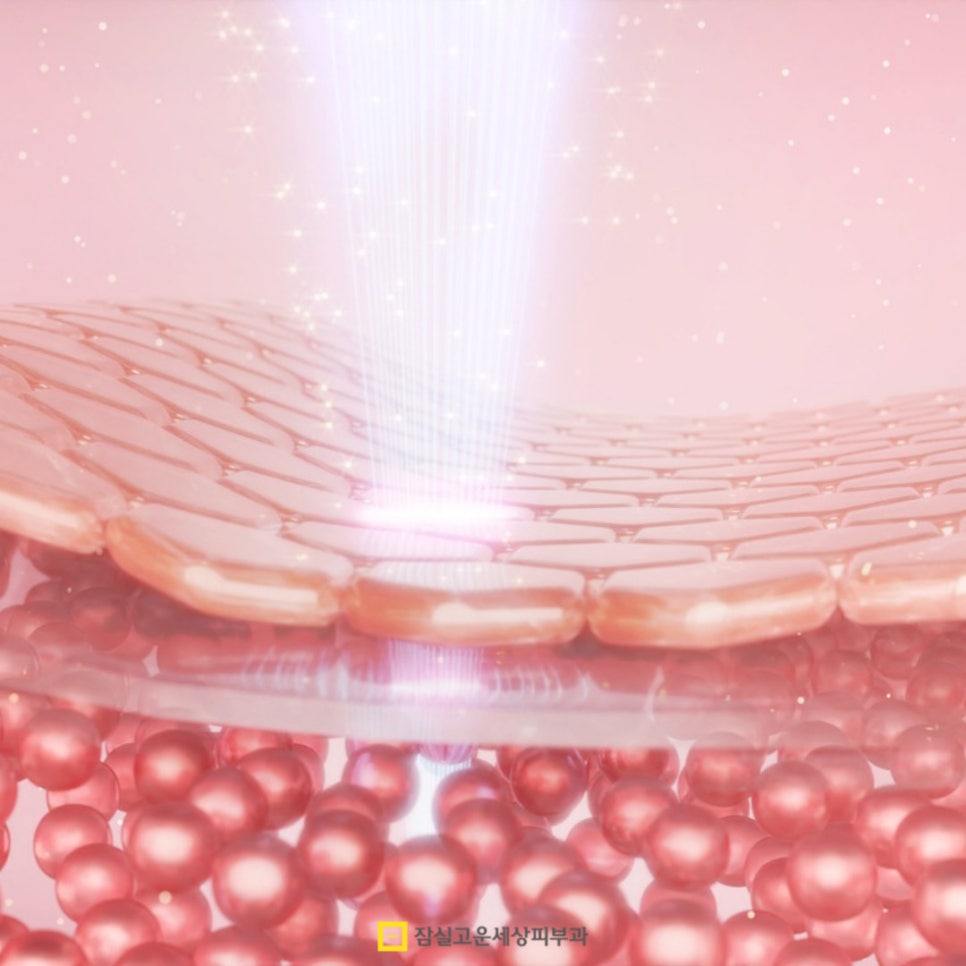 여름철 등드름과 가드름 완전 정복! 시원한 옷차림을 위한 완벽 가이드 관련 이미지 5