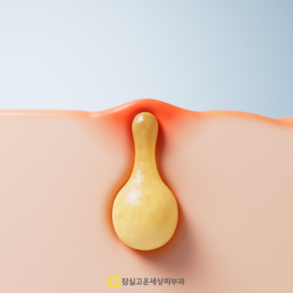 여드름, 왜 치료해도 다시 올라올가? 그리고 재발을 줄이는 방법 관련 이미지 3