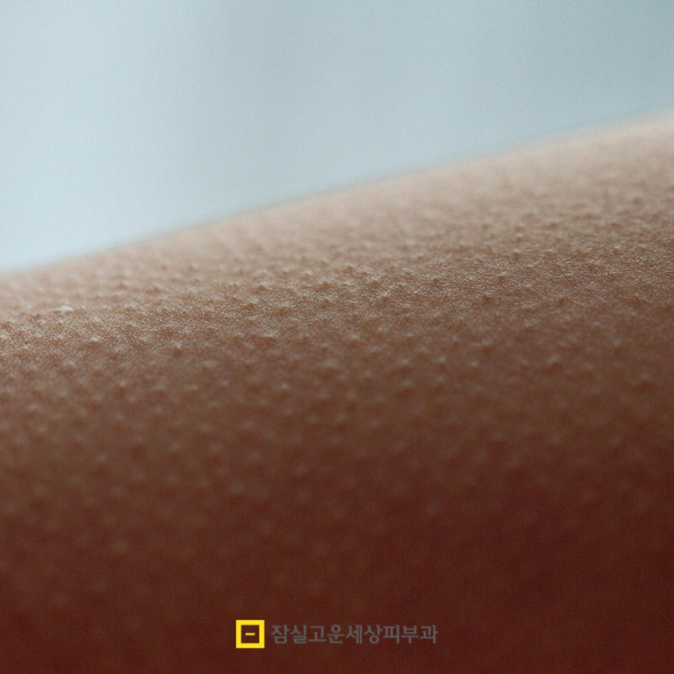 모공각화증, 단순한 관련 이미지 2