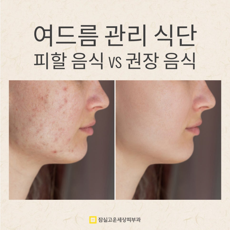 여드름 관리 식단, &lsquo;피해야 할 음식 vs 권장할 음식&rsquo; 관련 이미지 1