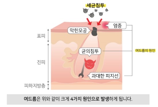 잠실여드름피부과 J핌클케어입니다 (잠실고운세상피부과/잠실역피부과) 관련 이미지 4