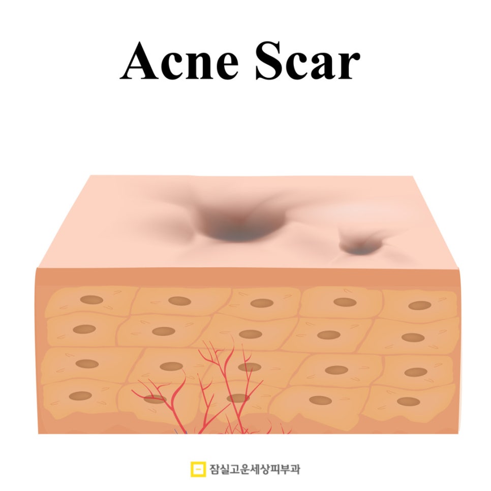 여드름 흉터, 시간이 지나도 사라지지 않는 이유 관련 이미지 4