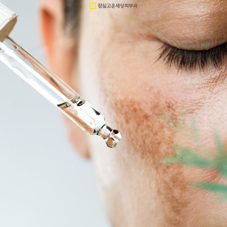 기미 원인부터 치료 방법, 예방이 중요한 이유까지 관련 이미지 3