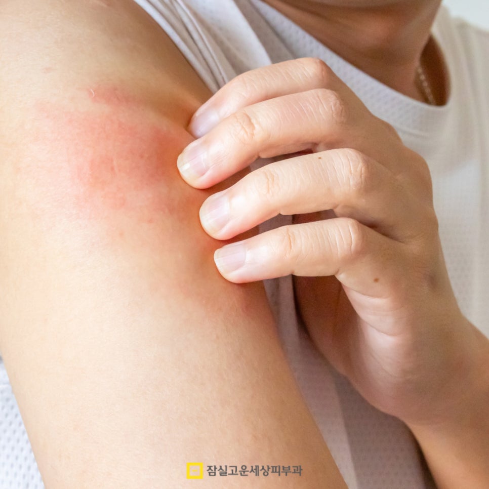 여름철 피부 발진, 제대로 알고 예방하는 방법 관련 이미지 6