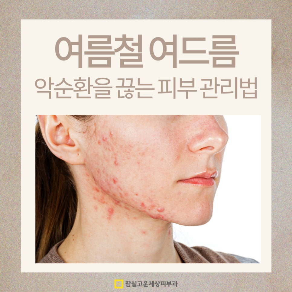 여름철 여드름, 악순환을 끊는 피부 관리법 관련 이미지 1
