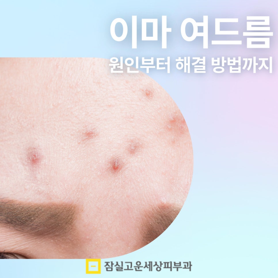 이마 여드름, 왜 자꾸 생길까? 관련 이미지 1