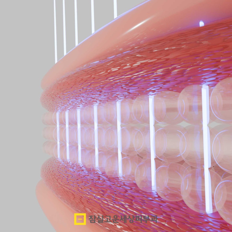 좁쌀 여드름, 왜 자꾸 올라올까요? 관련 이미지 4